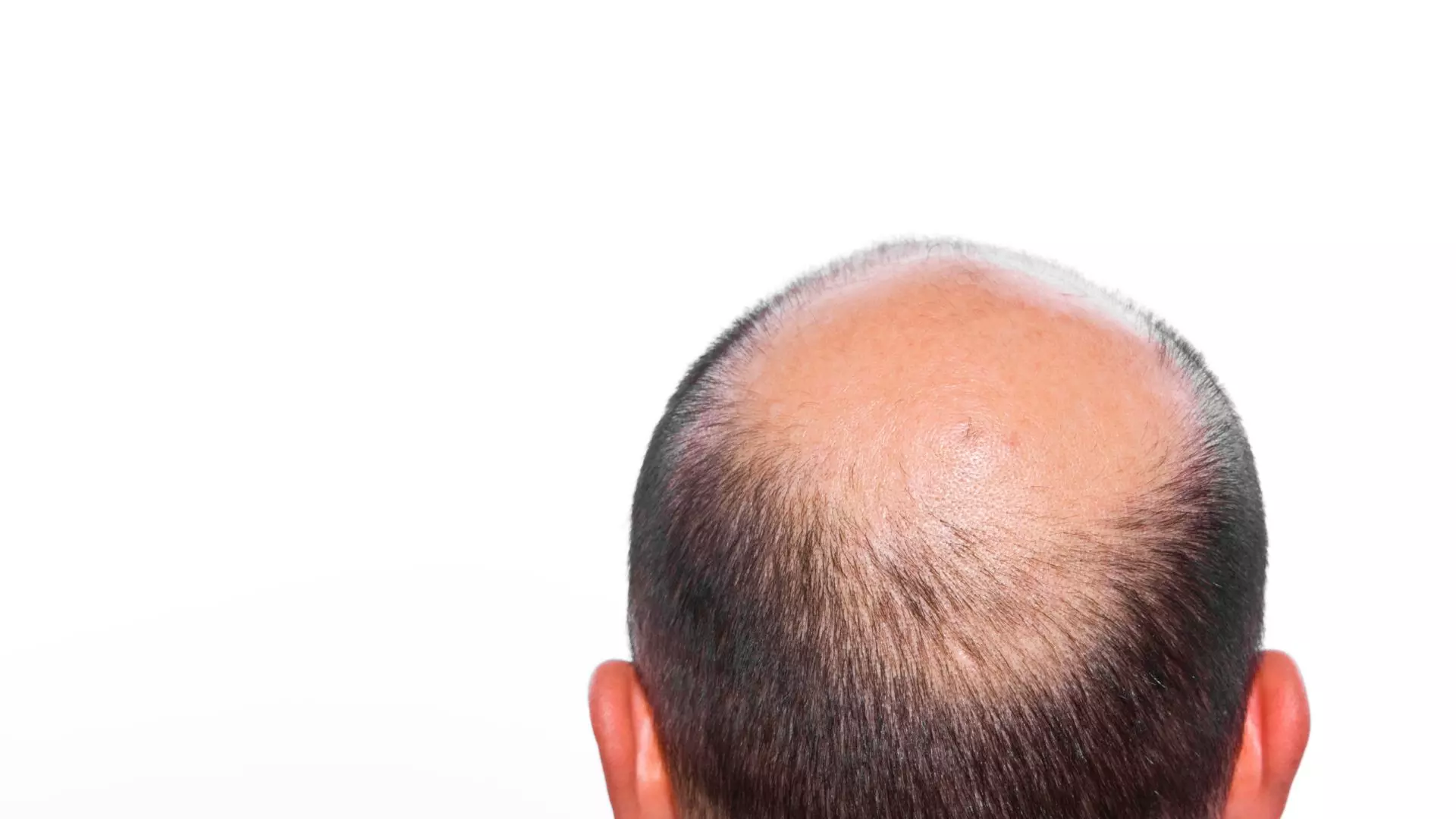 Łysienie androgenowe - czy przeszczep włosów jest skuteczny?