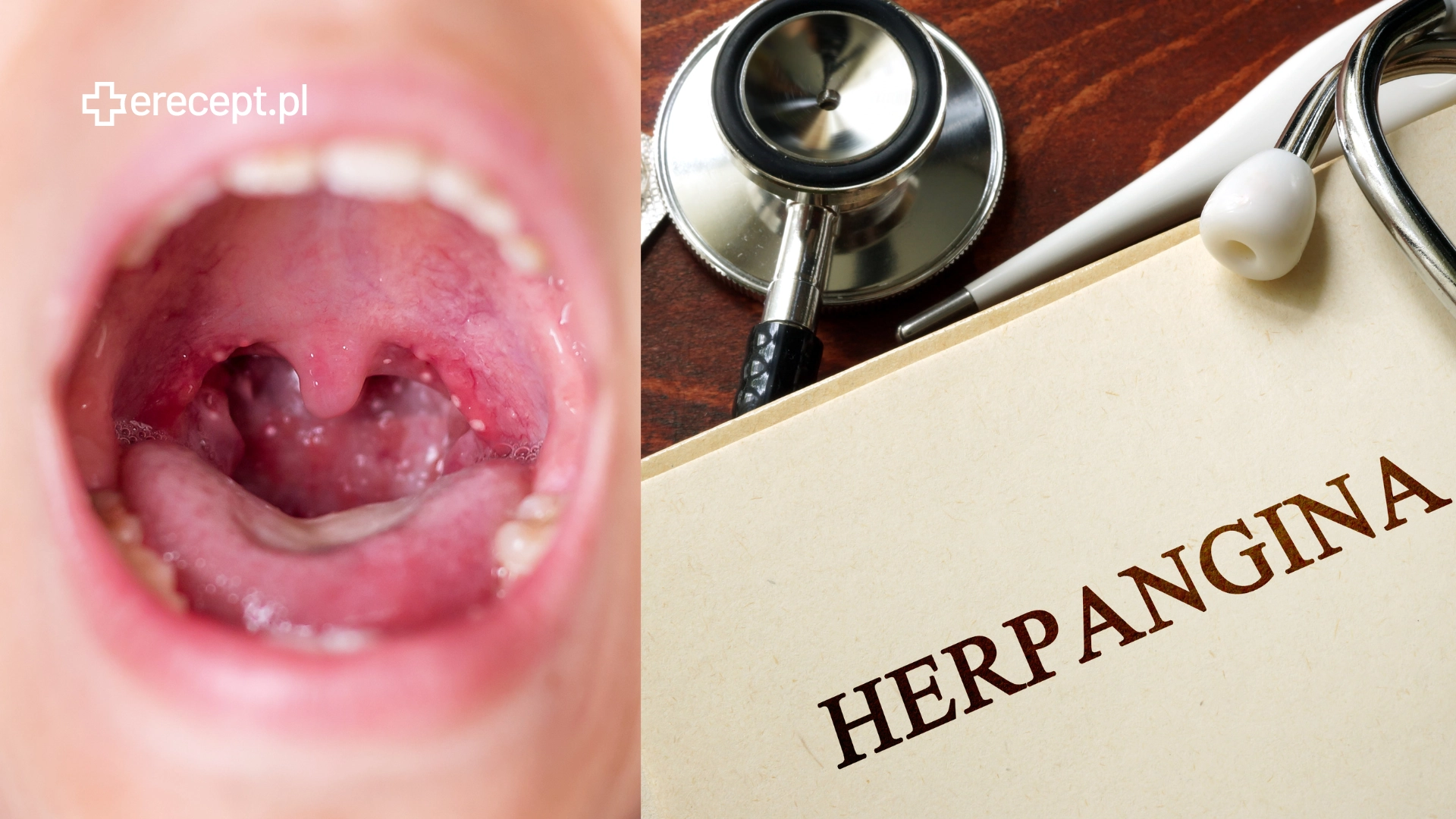 Herpangina   przyczyny  objawy i leczenie  Ile trwa?